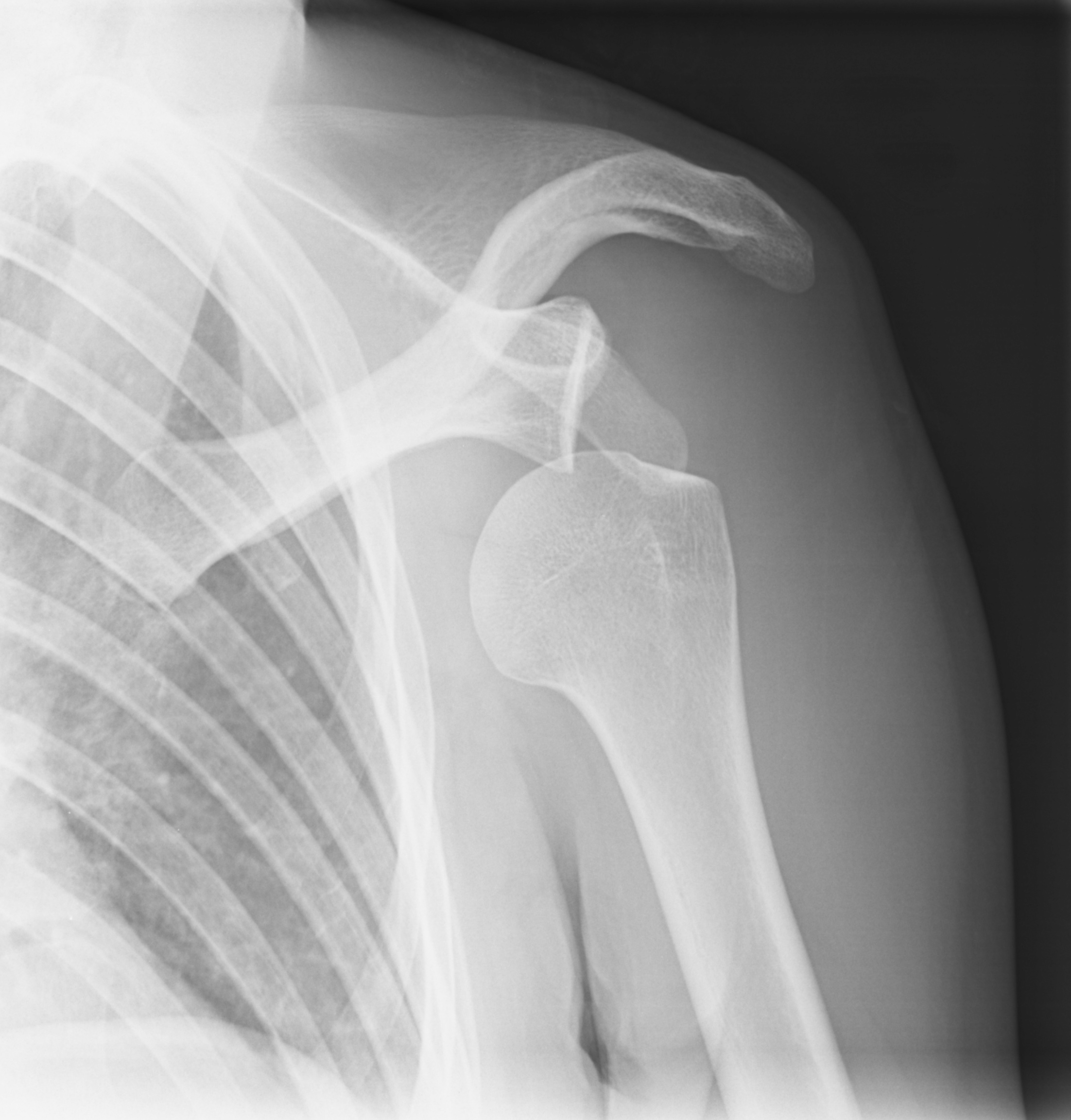 treating-a-dislocated-shoulder-dr-william-f-hefley